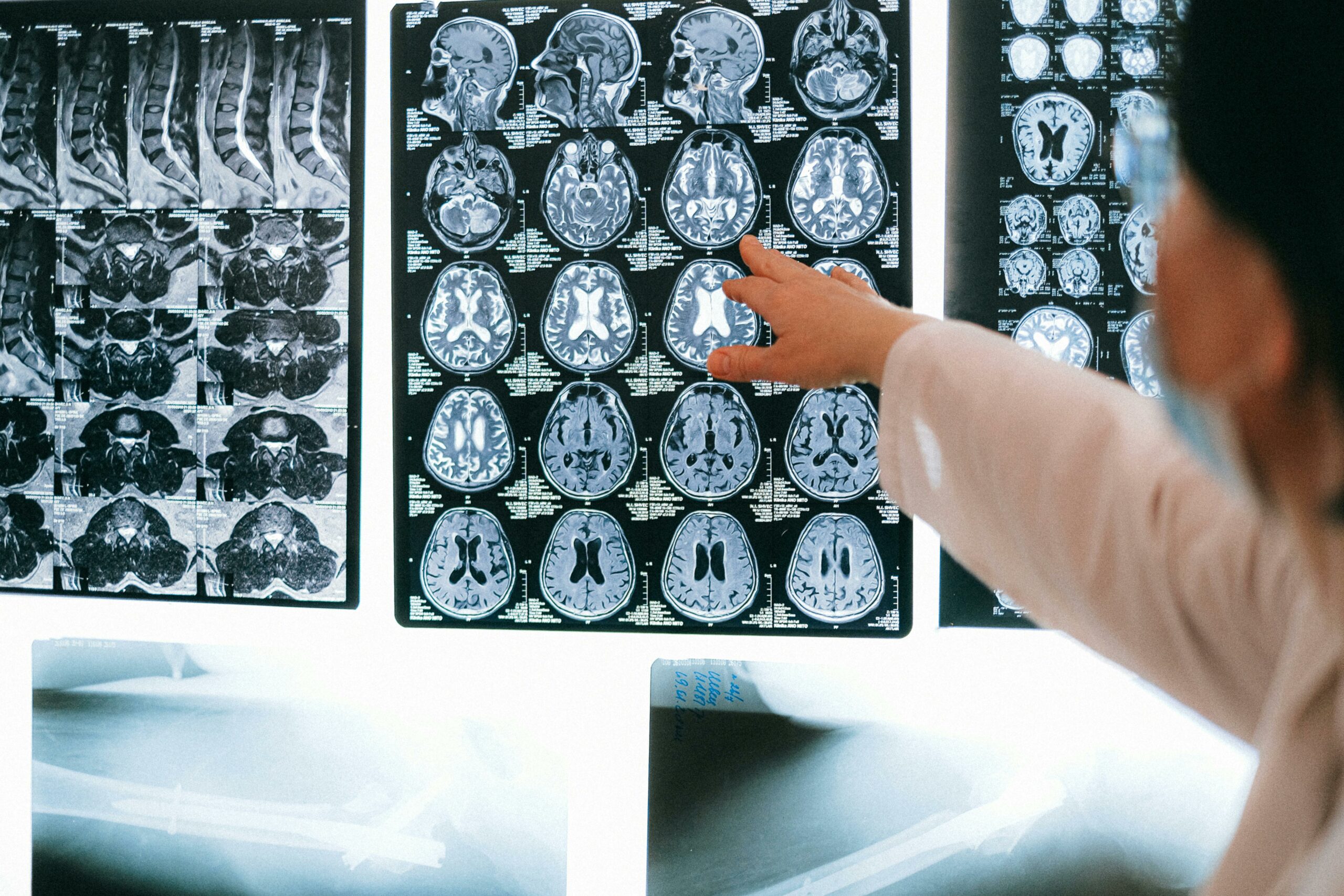 2025 HDBuzz-prijs: MR-“waarom” voel ik me zo? Hoe MRI ons helpt begrijpen waarom mensen met de ziekte van Huntington zich soms niet bewust zijn van hun symptomen